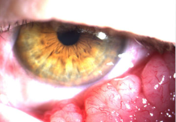 Gerötete Augen auf Grund entzündlicher Prozesse im vorderen Augenabschnitt
